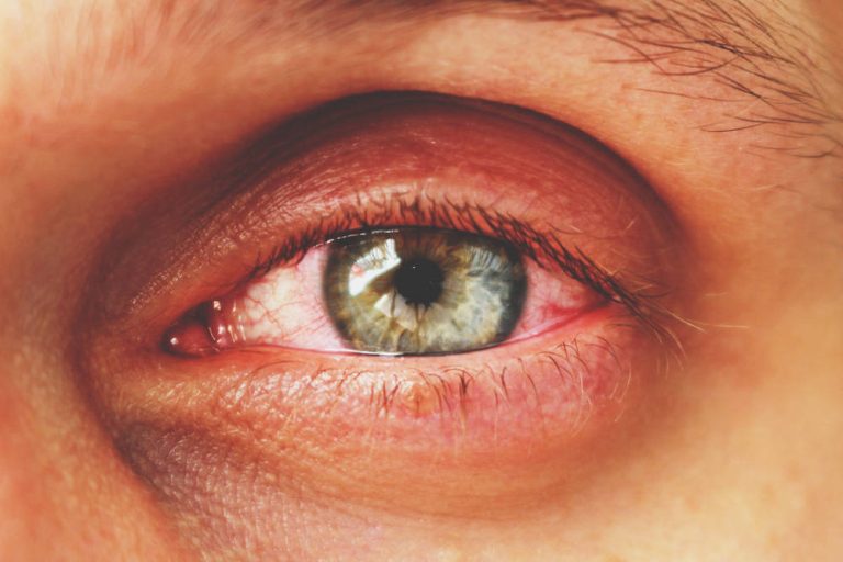 ¿Cuáles son las enfermedades oculares más comunes?